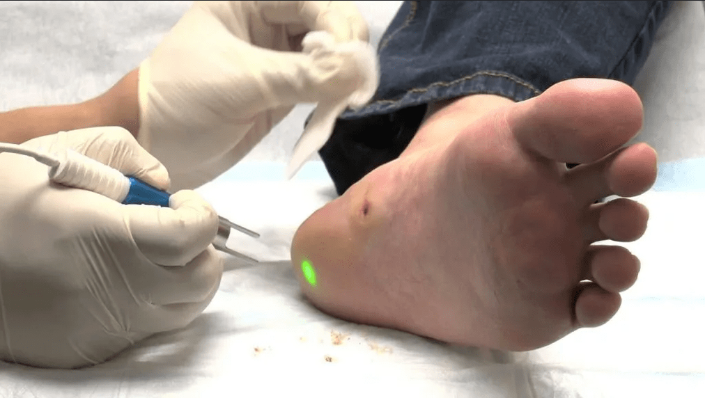 Treatment of nipple plant