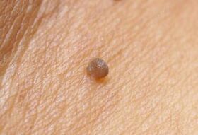 Clinical picture of a papillom