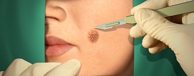 Surgical treatment of papilloma