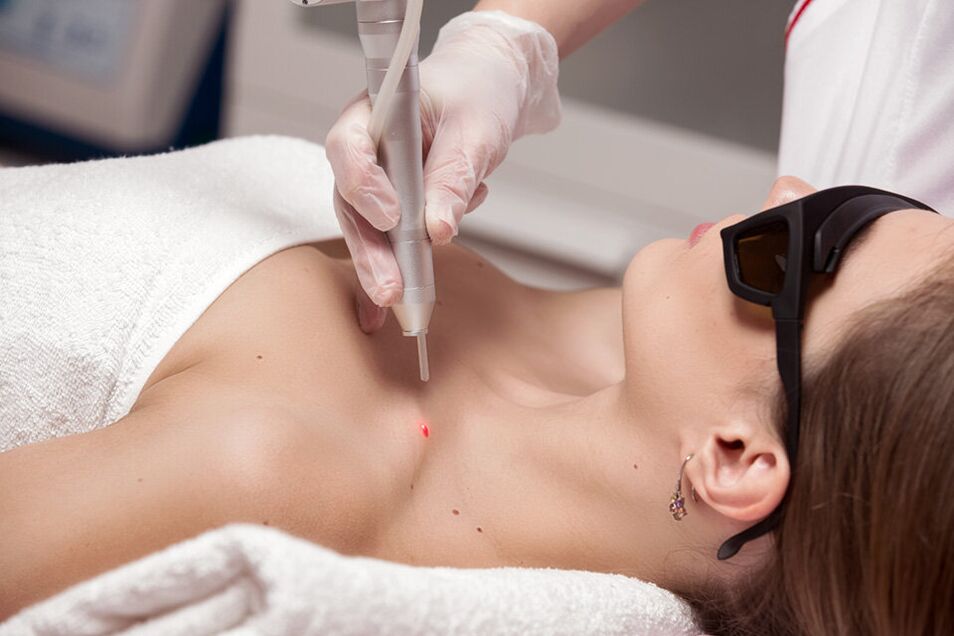 Laser removal of papillom