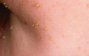 The reasons looks papillom on the body