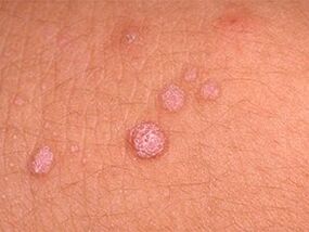 How to get rid of papillomes on your body