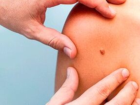 The reasons looks papillom on the body