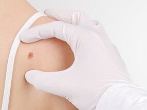 What is the danger of having papillomes on the body