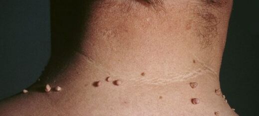 how to get rid of papilloma