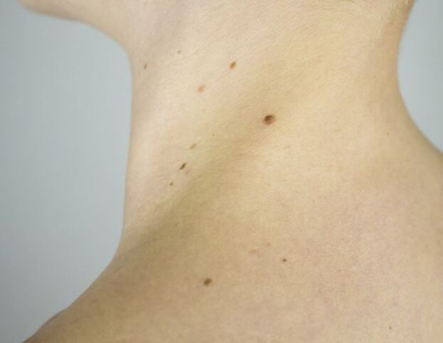 Papillomas on the neck in a girl
