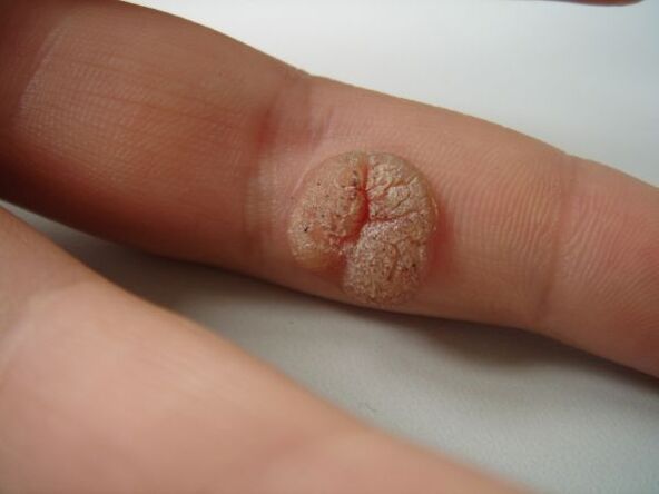 Complication of self-removal of papilloma