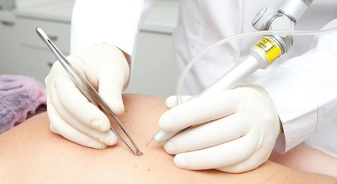 laser removal of papillomas due to papillomavirus