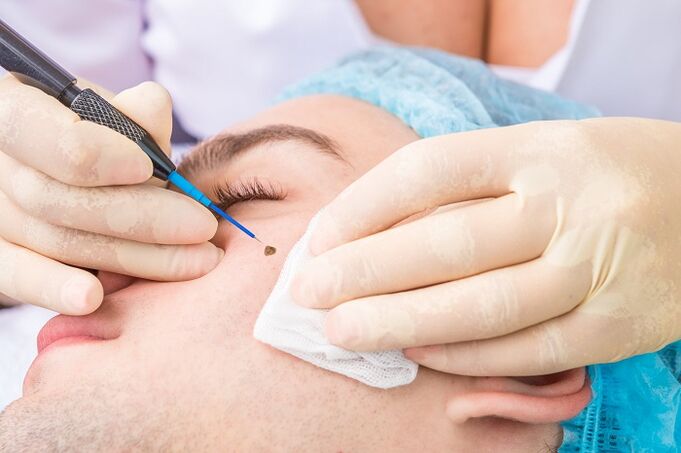 removal of facial papillomas due to human papilloma virus