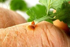 removal of papillomas with the juice of celandine plants
