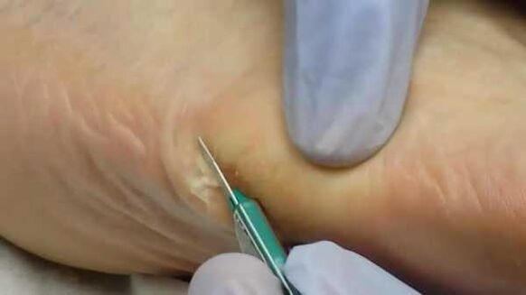 Surgical removal of the plantar wart