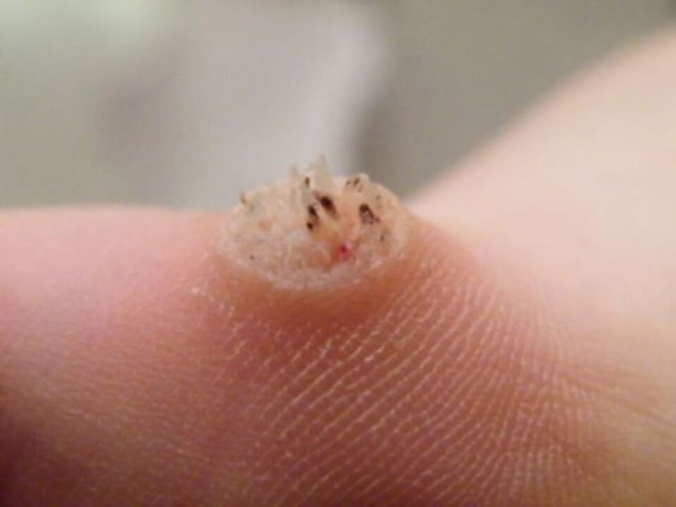 papilloma of the skin