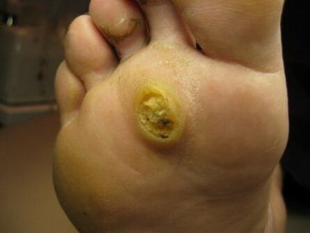 plantar warts