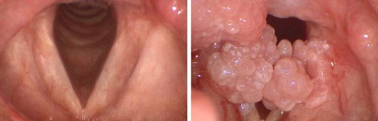 clear throat and papilloma of the pharynx