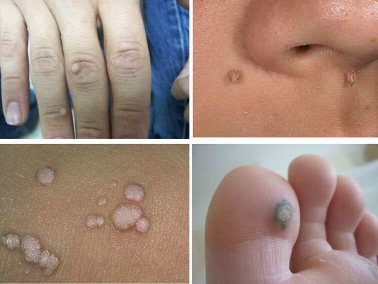 ordinary warts